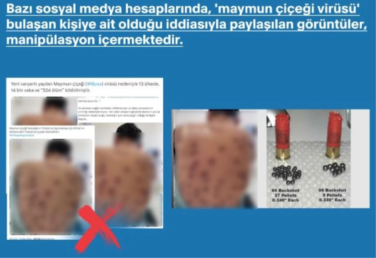 Maymun Çiçeği Virüsü İddiasıyla Paylaşılan Fotoğrafın Gerçek Yüzü Ortaya Çıktı